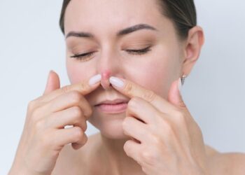 Jerawat di hidung. / Freepik