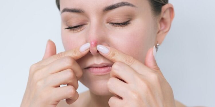 Jerawat di hidung. / Freepik